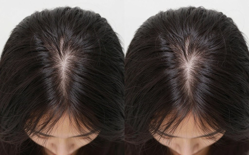 How to Tell If Your Hair Fall Is Temporary or a Sign of a Bigger Problem